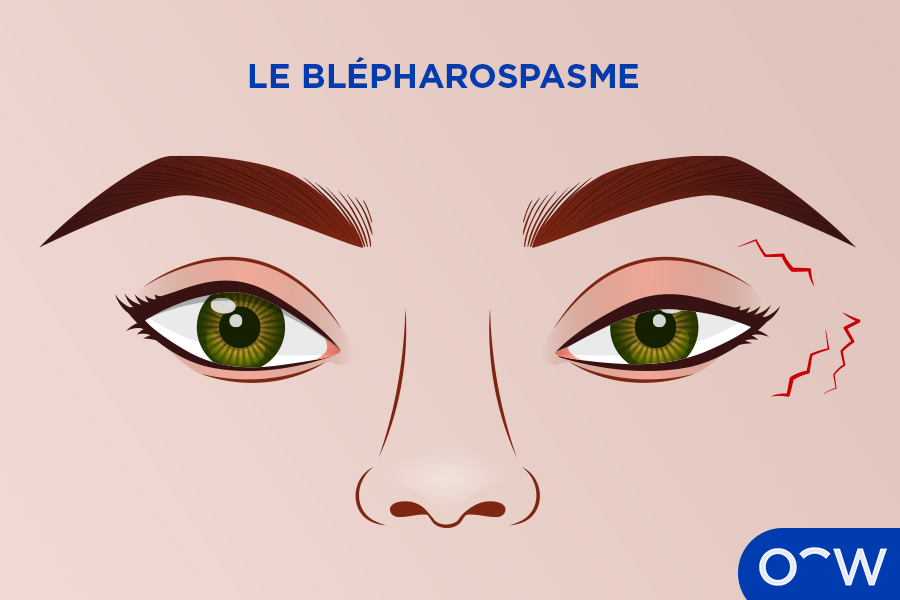 Des yeux avec des marques rouges sur la paupière, indiquant des tremblements.