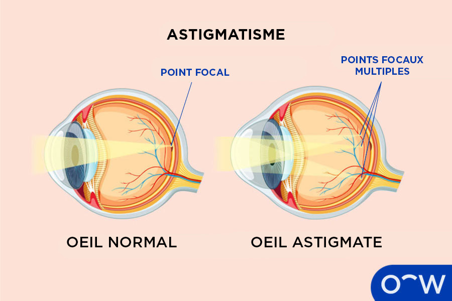 Un schéma illustrant comment l’astigmatisme provoque la focalisation des rayons lumineux sur de multiples points dans l’œil plutôt que sur un seul point.