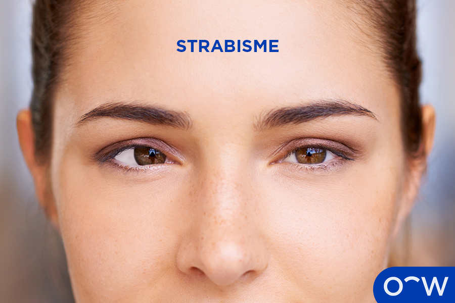Les yeux d’une femme montrant un strabisme, avec son œil droit
          tourné vers l’intérieur, alors que son œil gauche est positionné au
          centre.