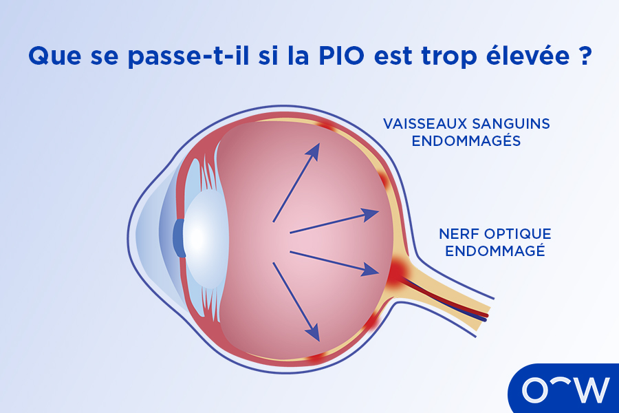 Une coupe transversale d'un œil glaucomateux, résultant d'une pression intraoculaire élevée.