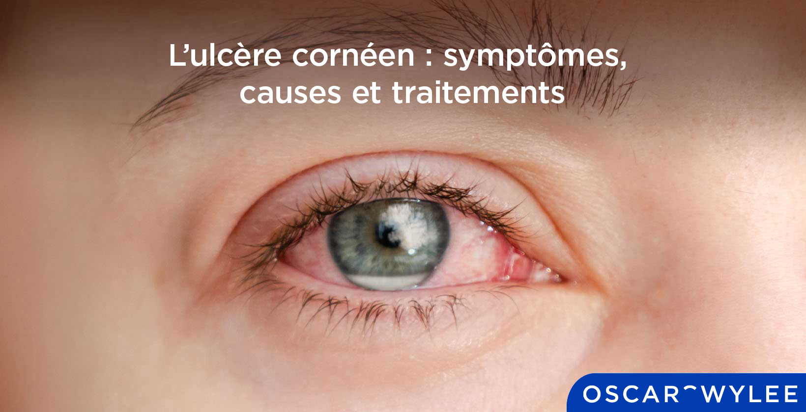 L’ulcère cornéen 