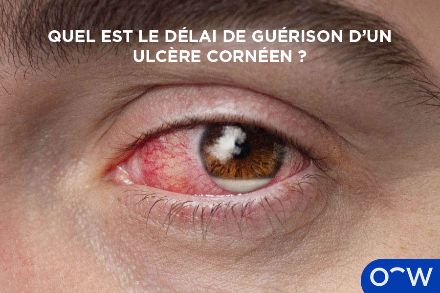 Une photo d’un gros plan d’un œil atteint d’un ulcère cornéen.