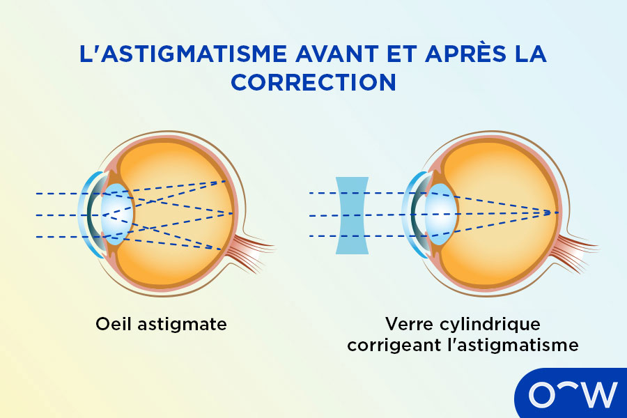 Un schéma illustrant la façon dont l'œil astigmate traite la lumière, avant et après la correction avec les verres.