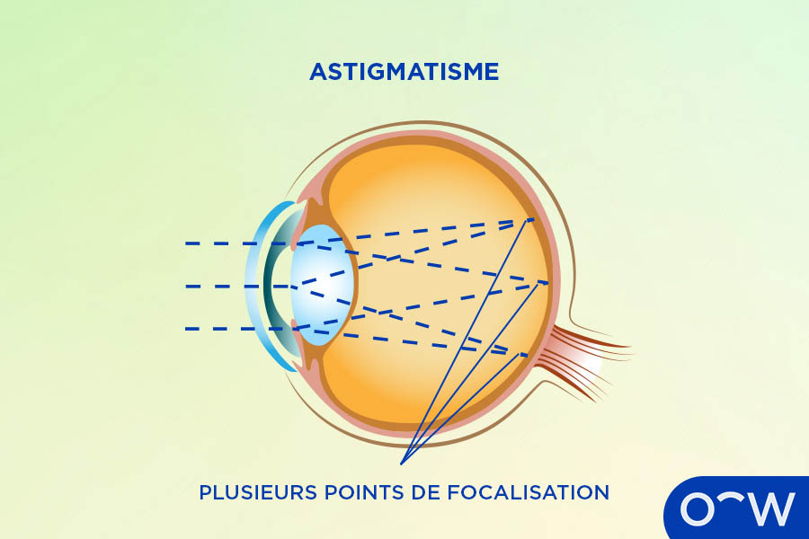 Un graphique montrant l’intérieur de l’œil illustrant une réfraction incorrecte de la lumière, représentant l’astigmatisme, une des nombreuses causes de la vision déformée