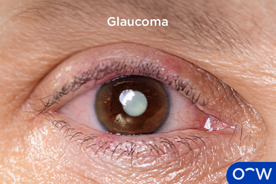 An eye affected by glaucoma.