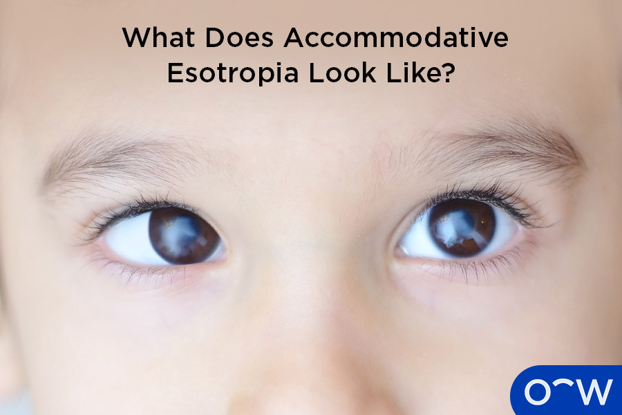 A person with accommodative esotropia, with one eye turned inwards towards the nose.