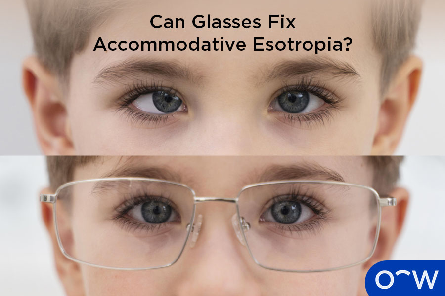 A person with accommodative esotropia without glasses, with their eye turned inwards, next to someone with accommodative esotropia wearing glasses, with the eye facing the front as normal.