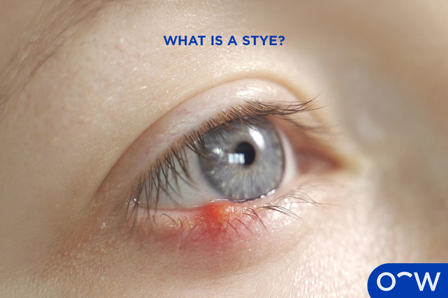 A close-up of an eye with a stye.