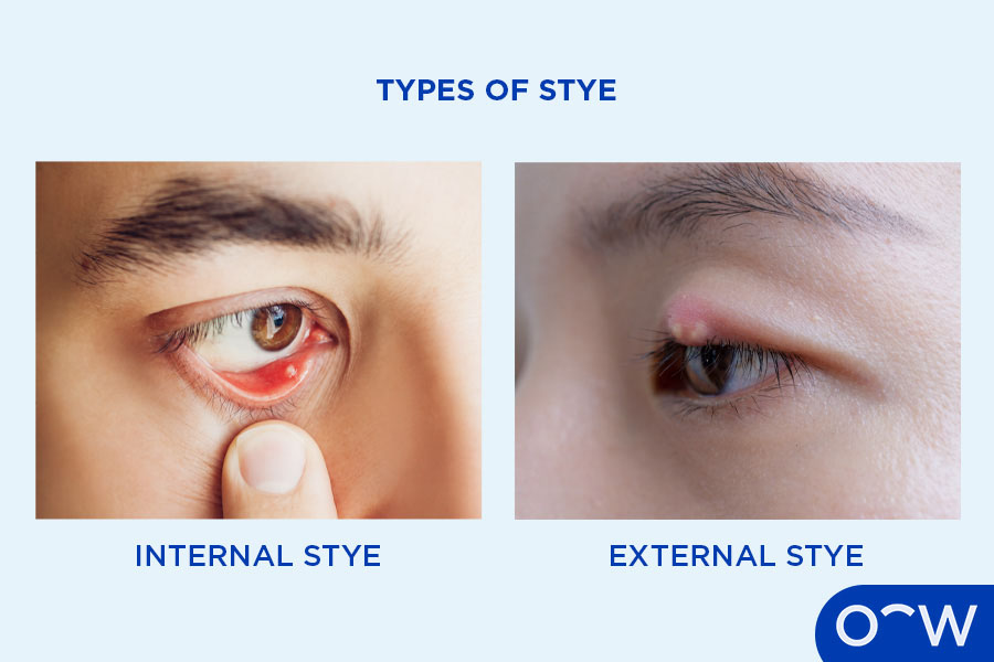 Two images, one with an internal stye on the inside of the eyelid and one with an external stye on the outside of the eye near the base of the eyelashes.