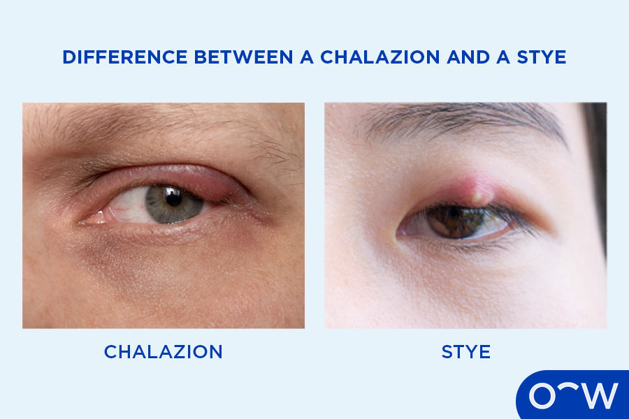 Two images, one of a stye on the eye and one of a chalazion on the eye.
