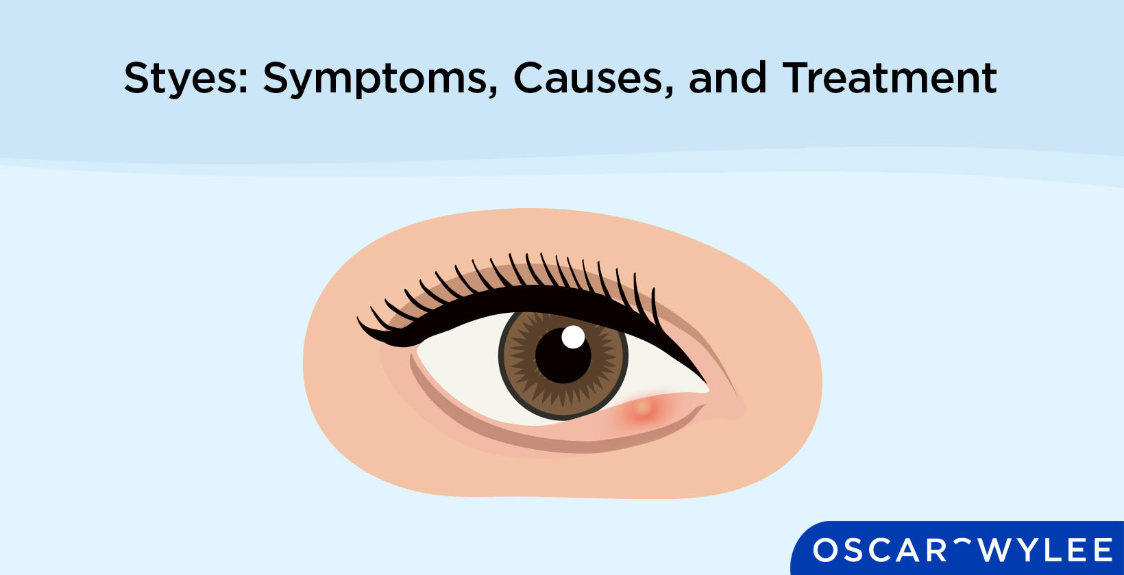 Stye Eye