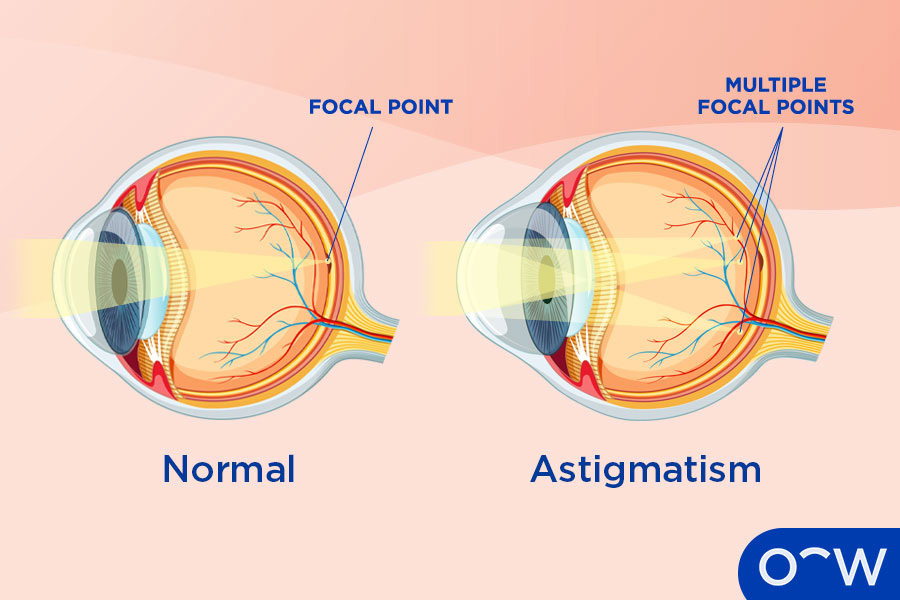 Astigmatism Definition Causes Symptoms Risk Factor And Treatment Astigmatism Definition Causes Symptoms Risk Factor And Treatment