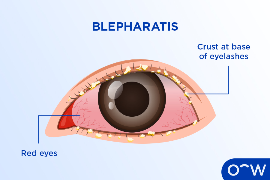 An illustrated eye with the eye condition blepharitis.