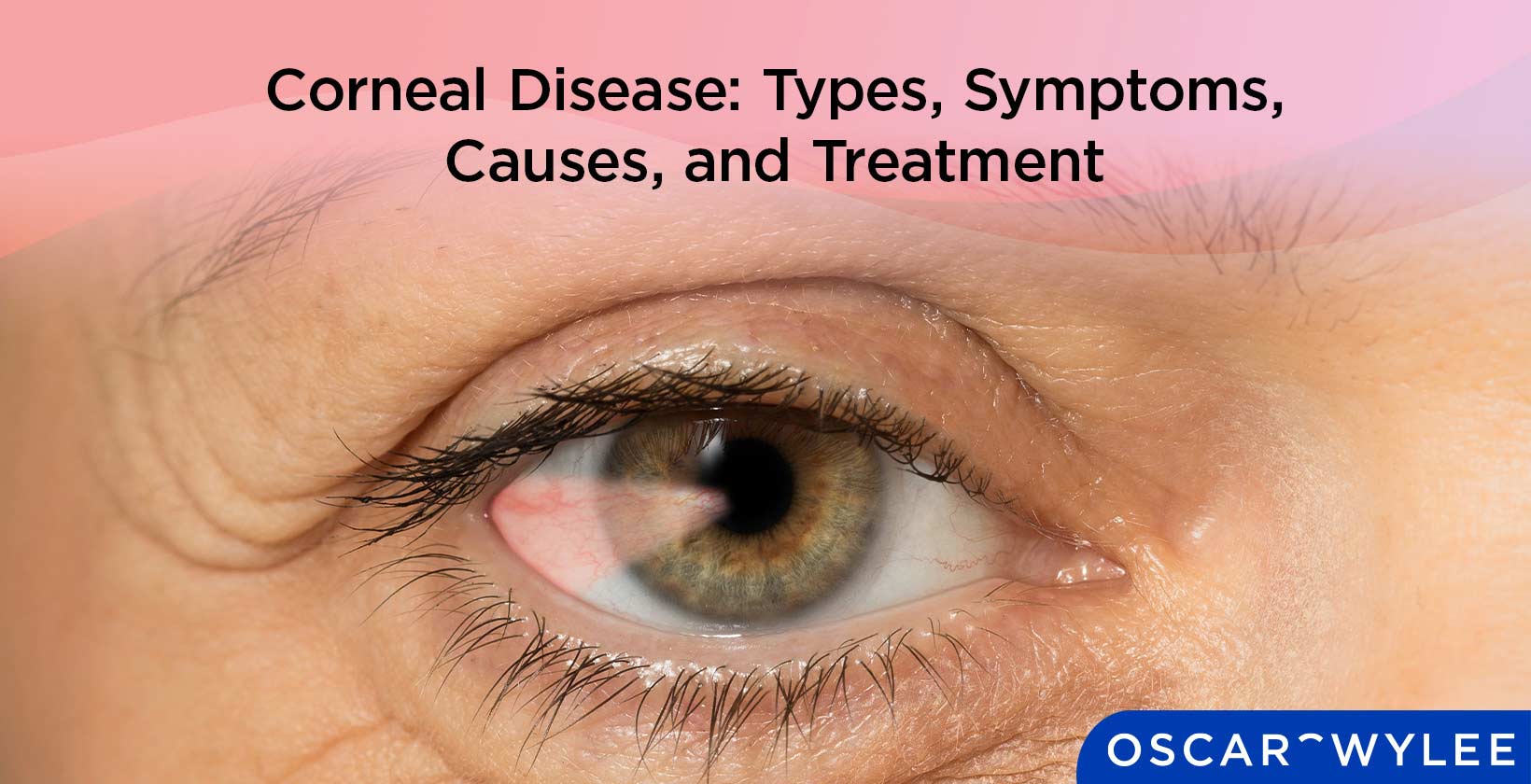 Corneal Diseases