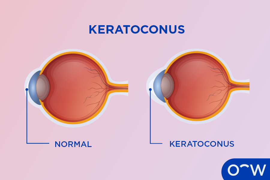 Diagram of the corneal disease type, keratoconus, and its bulging effect on the cornea.