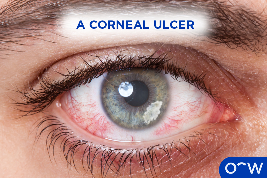 A white, greyish spot in the cornea, known as a corneal ulcer