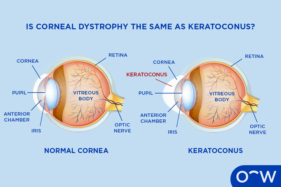 A diagram of a normal cornea, next to a diagram of a cornea with keratoconus.