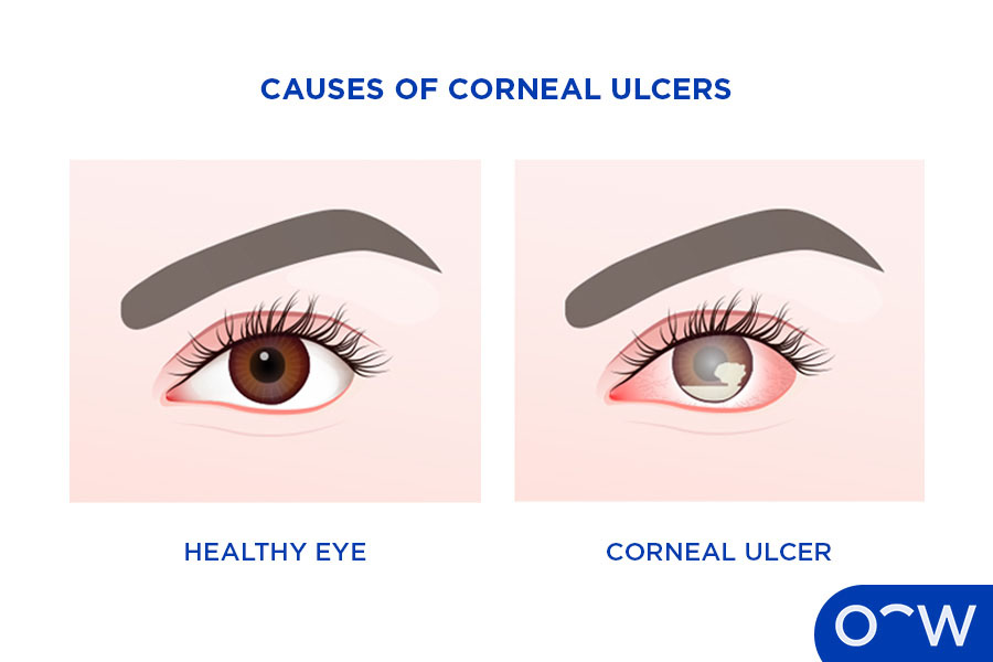 Two photos: one of a healthy eye and one affected by corneal ulcer.