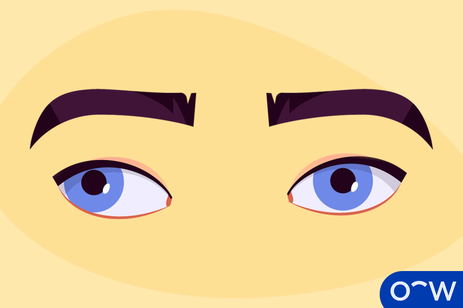 Exotropia (Outward Turning)