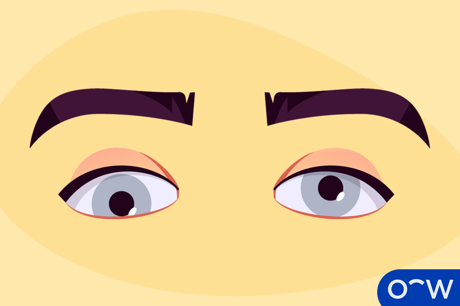 Hypotropia (Downward Turning)