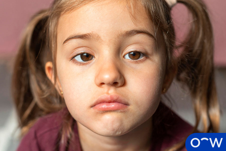 Who commonly has Crossed Eyes?