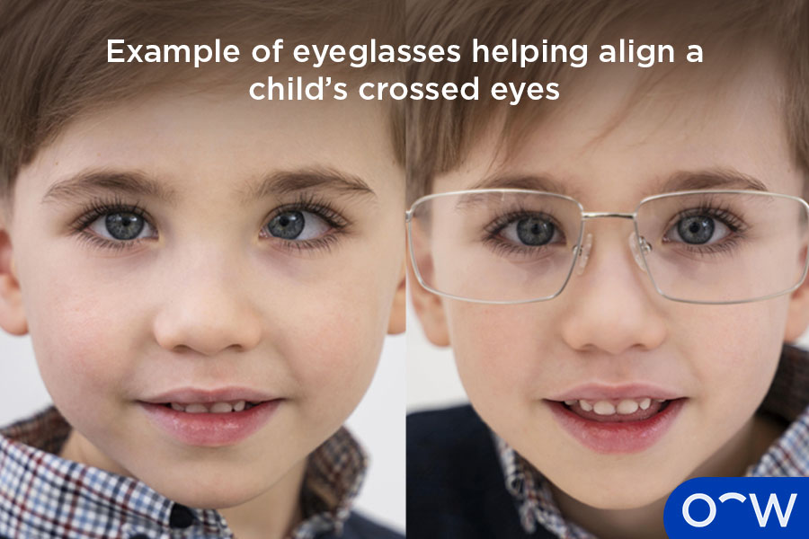 Example of eyeglasses helping align a child’s crossed eyes.