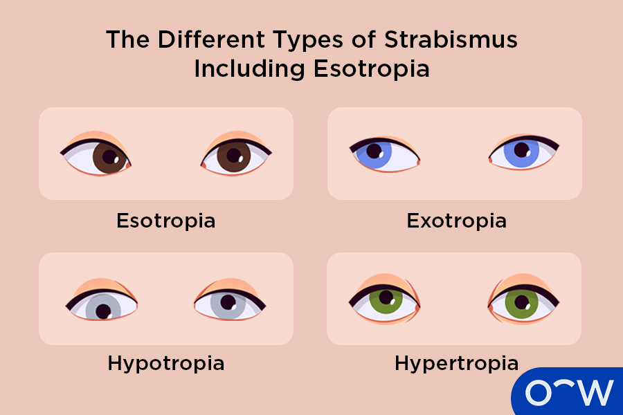 Example of how esotropia differs from the other types of strabismus