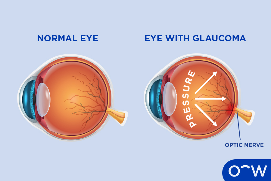 Image of a normal eye compared to an eye with glaucoma