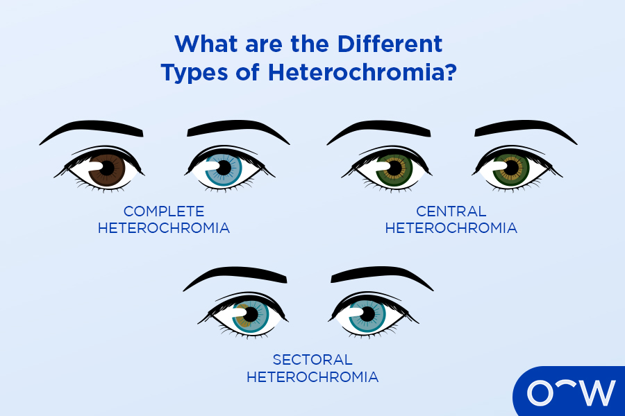Three pictures of eyes, each with a type of heterochromia, including complete heterochromia, central heterochromia and sectoral heterochromia.