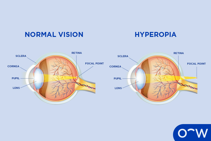 An image showing an eye with hyperopia and the parts that it affects, compared to an eye without hyperopia.