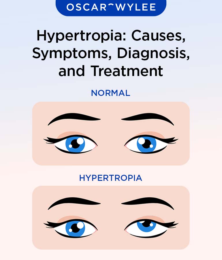 Hypertropia: Causes, Symptoms, Diagnosis, and Treatment