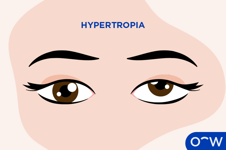 A person who has hypertropia with one eye upward-turning.