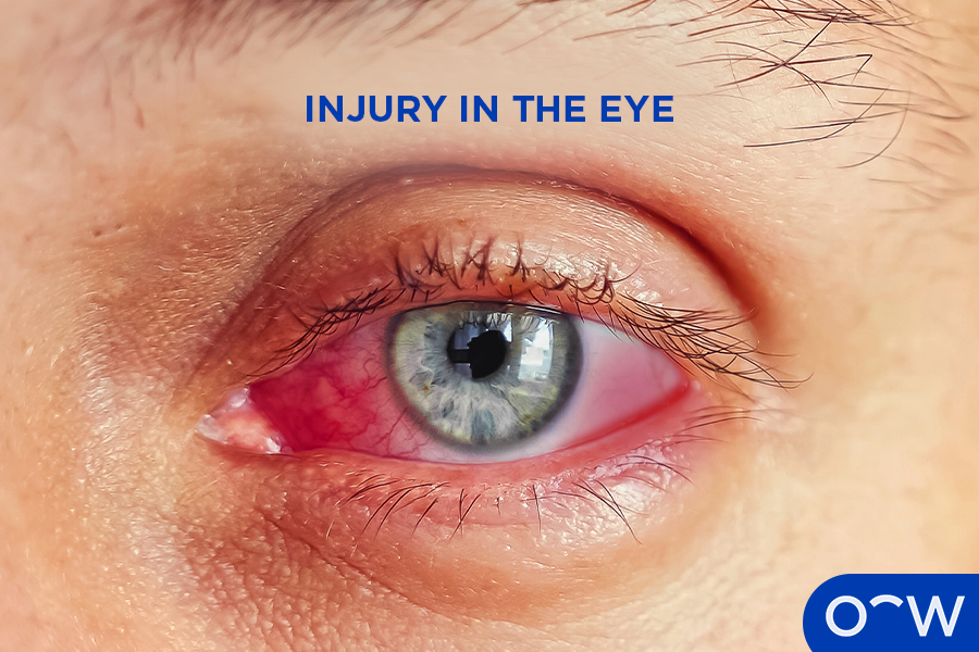 A person who has had an eye injury making their eye red and irritated.