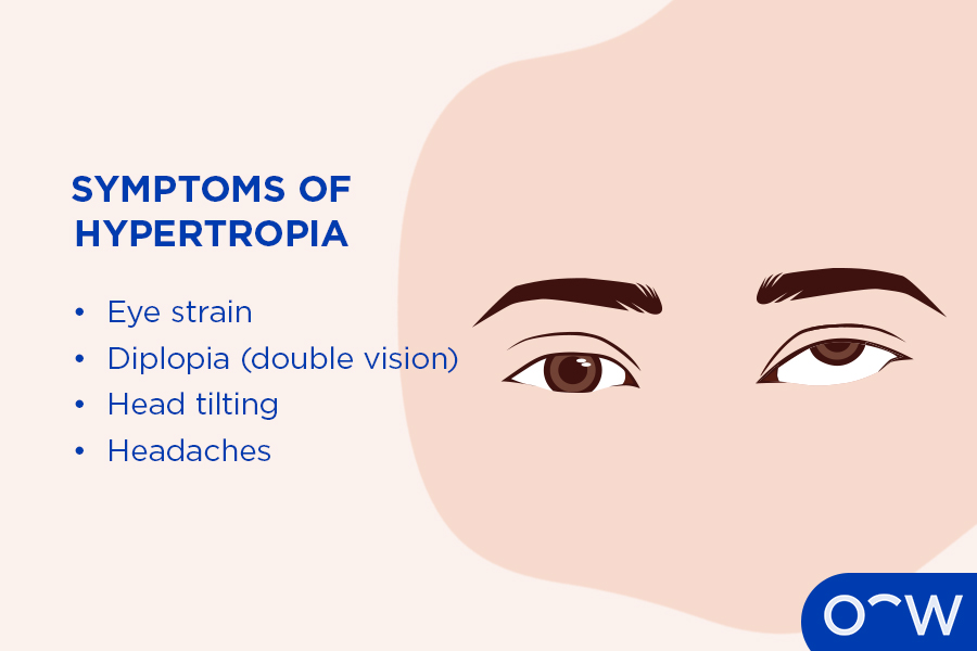 A list of the hypertropia symptoms accompanied by a pair of eyes with hypertropia.