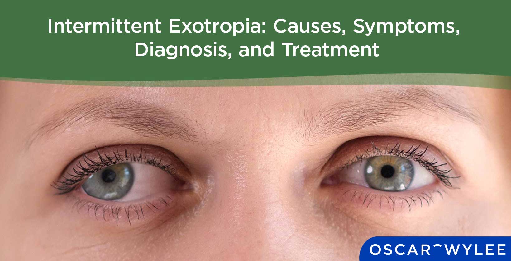 Intermittent Exotropia.