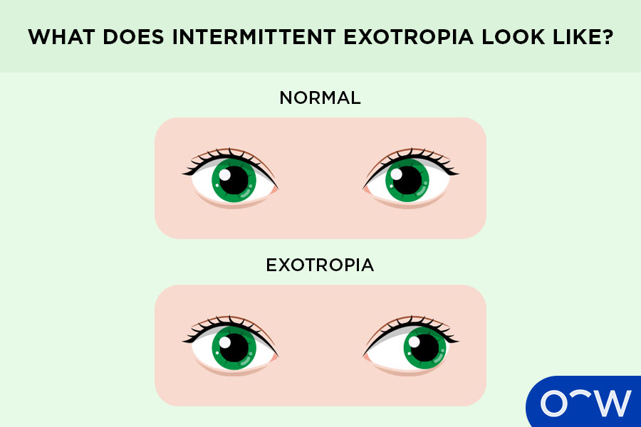 Eyes without intermittent exotropia looking straight, and an eye with intermittent exotropia turning or deviating towards the ear.