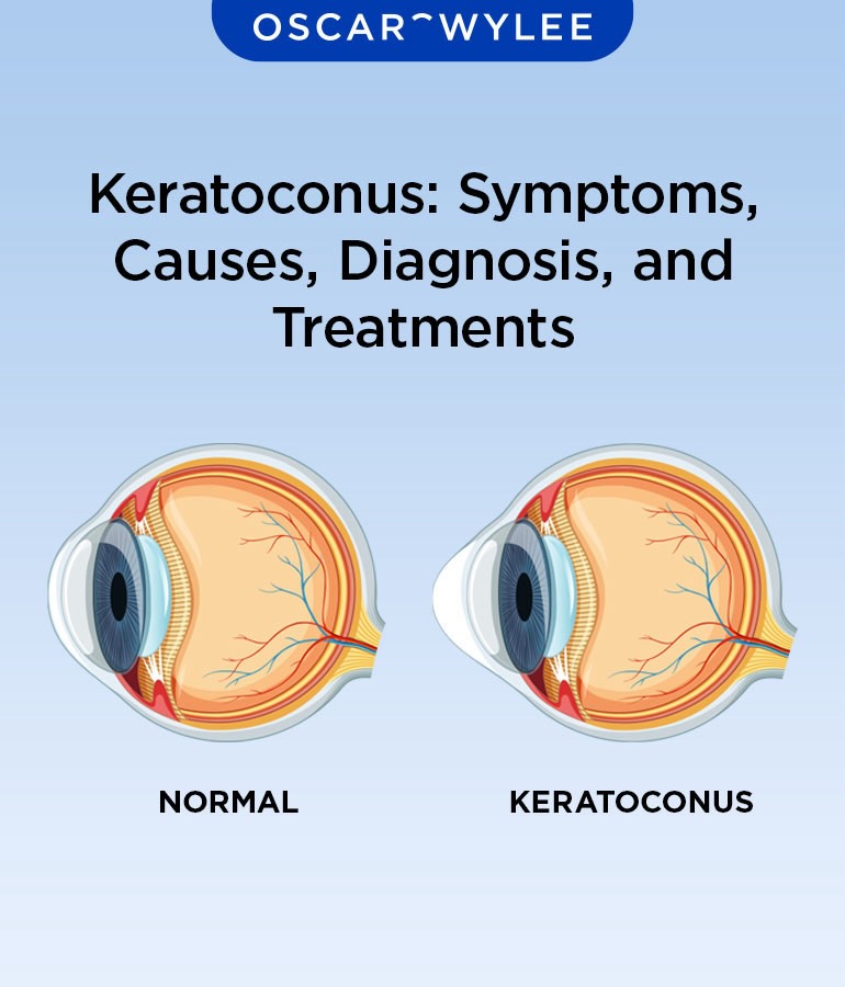 Keratoconus.