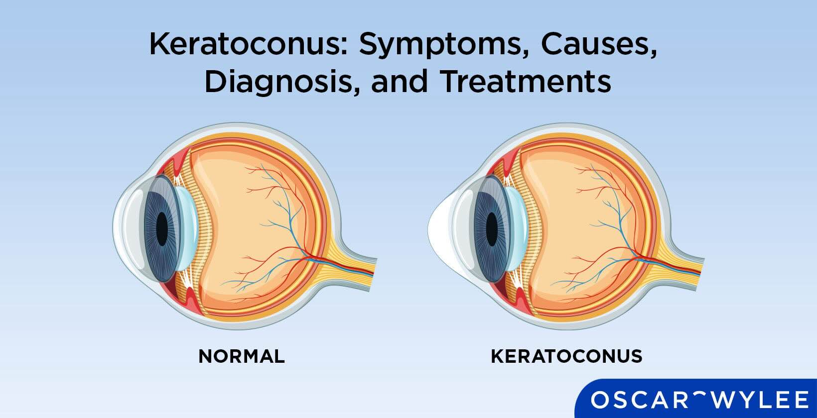 Keratoconus.