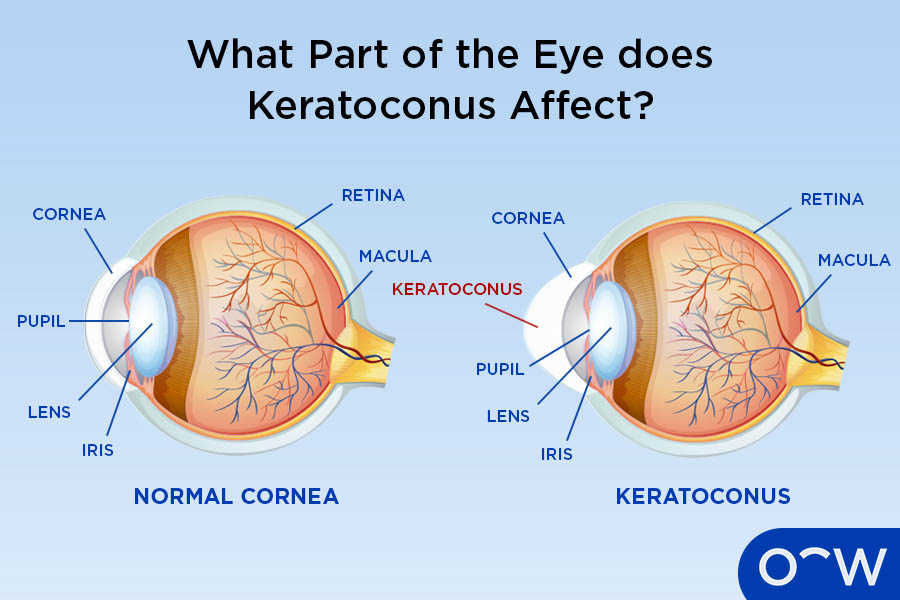 A labelled cross section of a normal eye with a dome shaped cornea, next to a labelled cross section of an eye with keratoconus, with the cornea a cone shape.