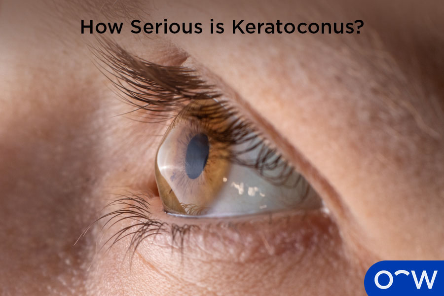 A close up of an eye that has been visually affected by keratoconus, with the cornea a cone shape.
