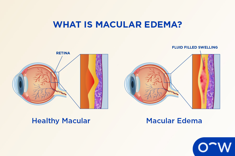 A cross-section of two eyes, one that is healthy and one that has macular edema, showing how the macula looks different with fluid swelling.