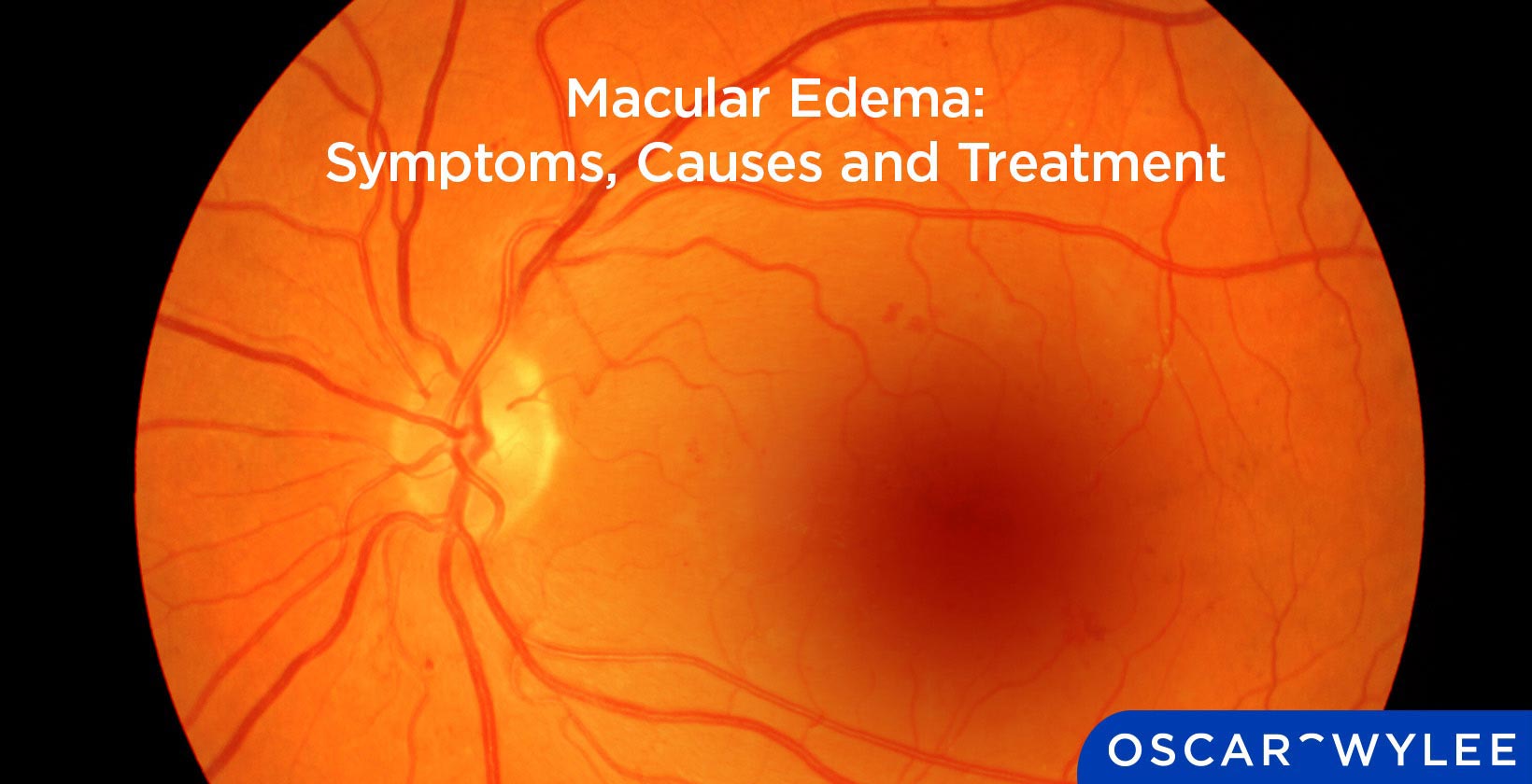Macular Edema