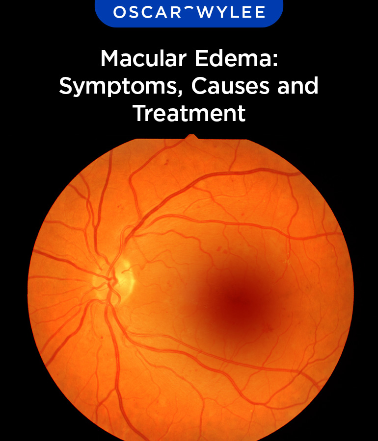 Macular Edema