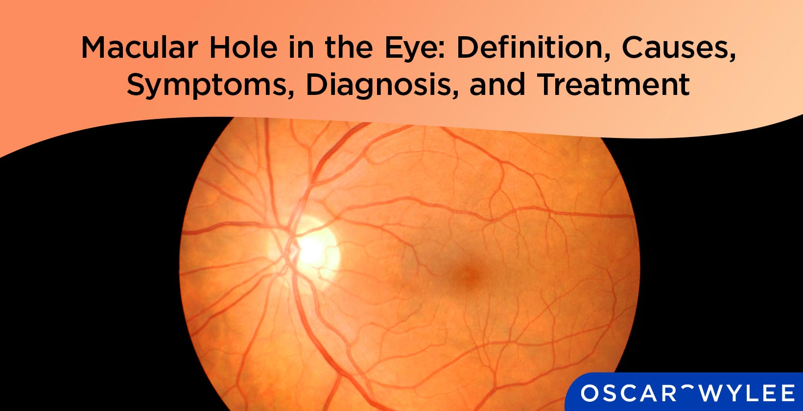 Macular Hole in the Eye.