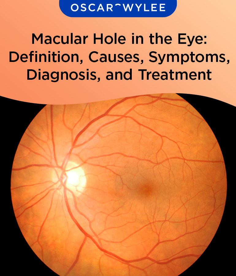 Macular Hole in the Eye.