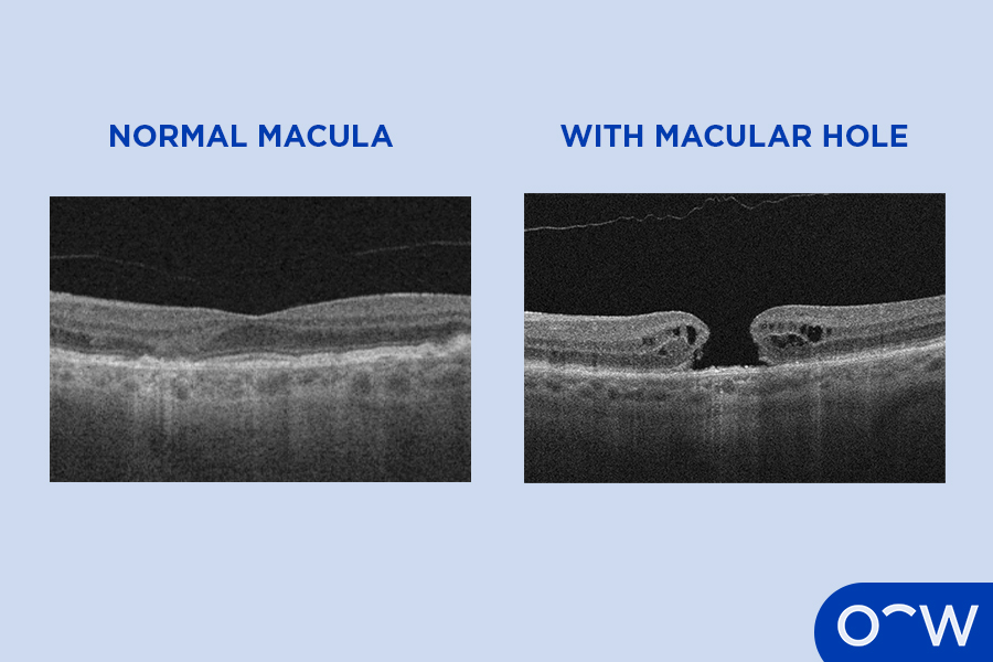 A macula with a hole in it vs a normal macula, shown on a scan.