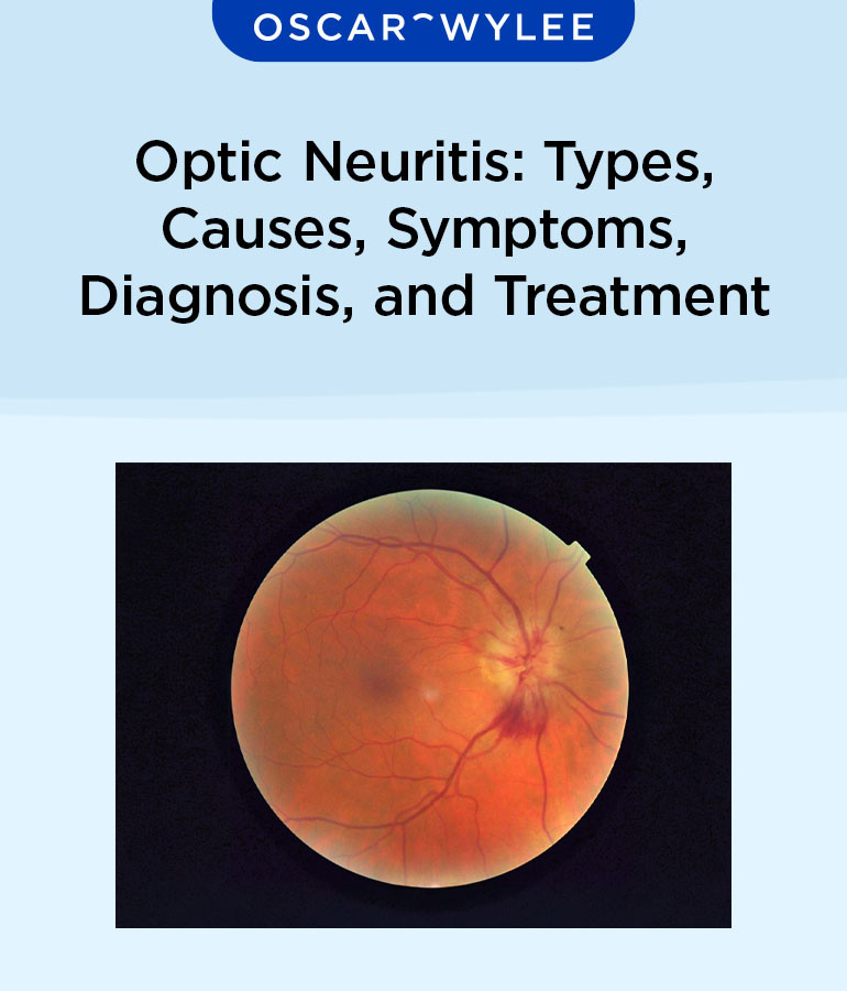 Optic Neuritis