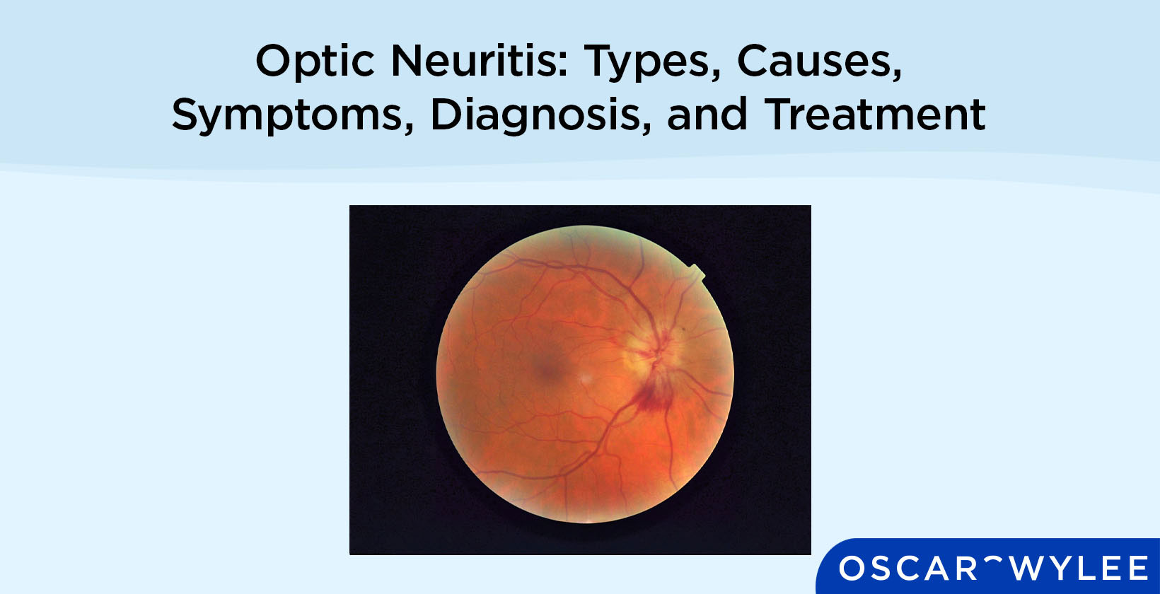 Optic Neuritis
