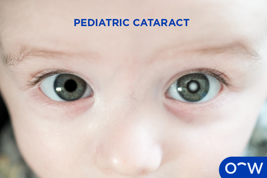 A child with a pediatric cataract in one eye.