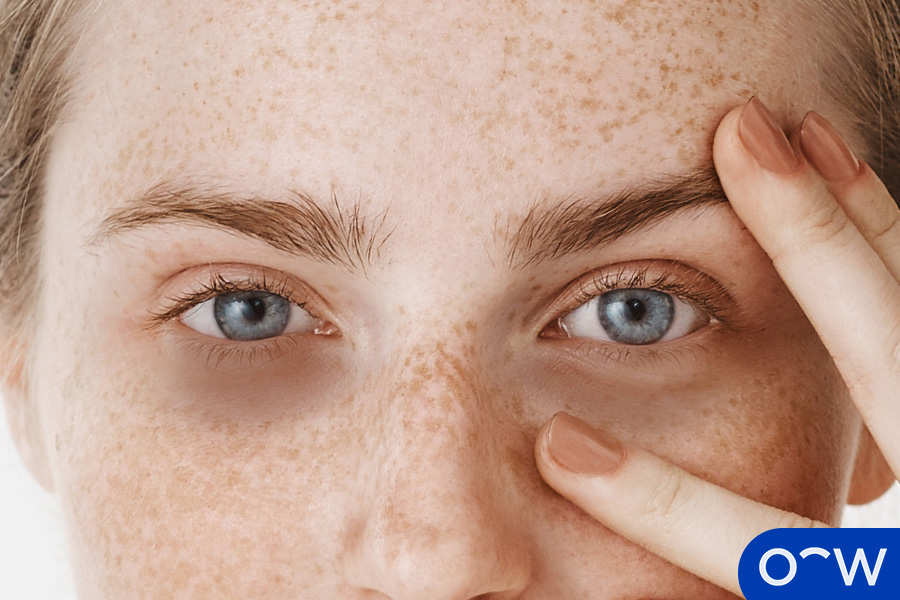 Puffy Eyes Definition, Causes, Symptoms, and Treatment